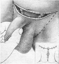 Χειρουργική επιμήκυνση του πέους τραβώντας το κρυμμένο τμήμα του