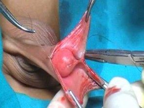 Χειρουργική μεγέθυνσης ανδρικού πέους